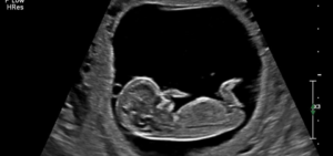 2D Baby Ultrasound Gender Reveal Hanford CA