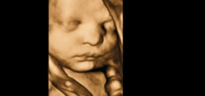 3d Baby Ultrasound Hanford CA